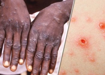 How concerned should we be about monkeypox?